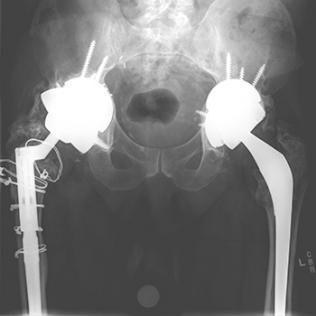 X-ray of hip replacement 